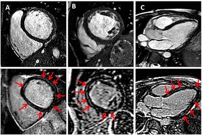 Midwall Fibrosis and Cardiac Mechanics: Rigid Body Rotation Is a Novel Marker of Disease Severity in Pediatric Primary Dilated Cardiomyopathy